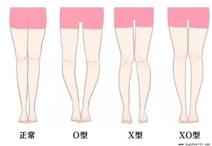 布骨医学科普、膝关节、膝过伸、布骨康复 布骨医学科普、膝关节、膝过伸、布骨康复