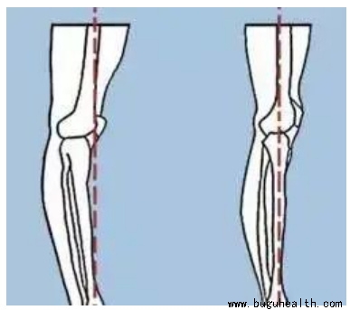 布骨医学科普、布骨康复 布骨医学科普、布骨康复