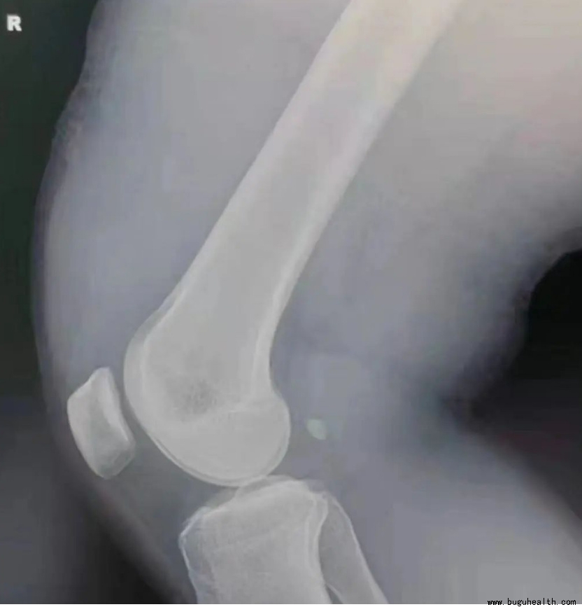 布骨医学科普、肌骨康复、布骨康复 布骨医学科普、肌骨康复、布骨康复